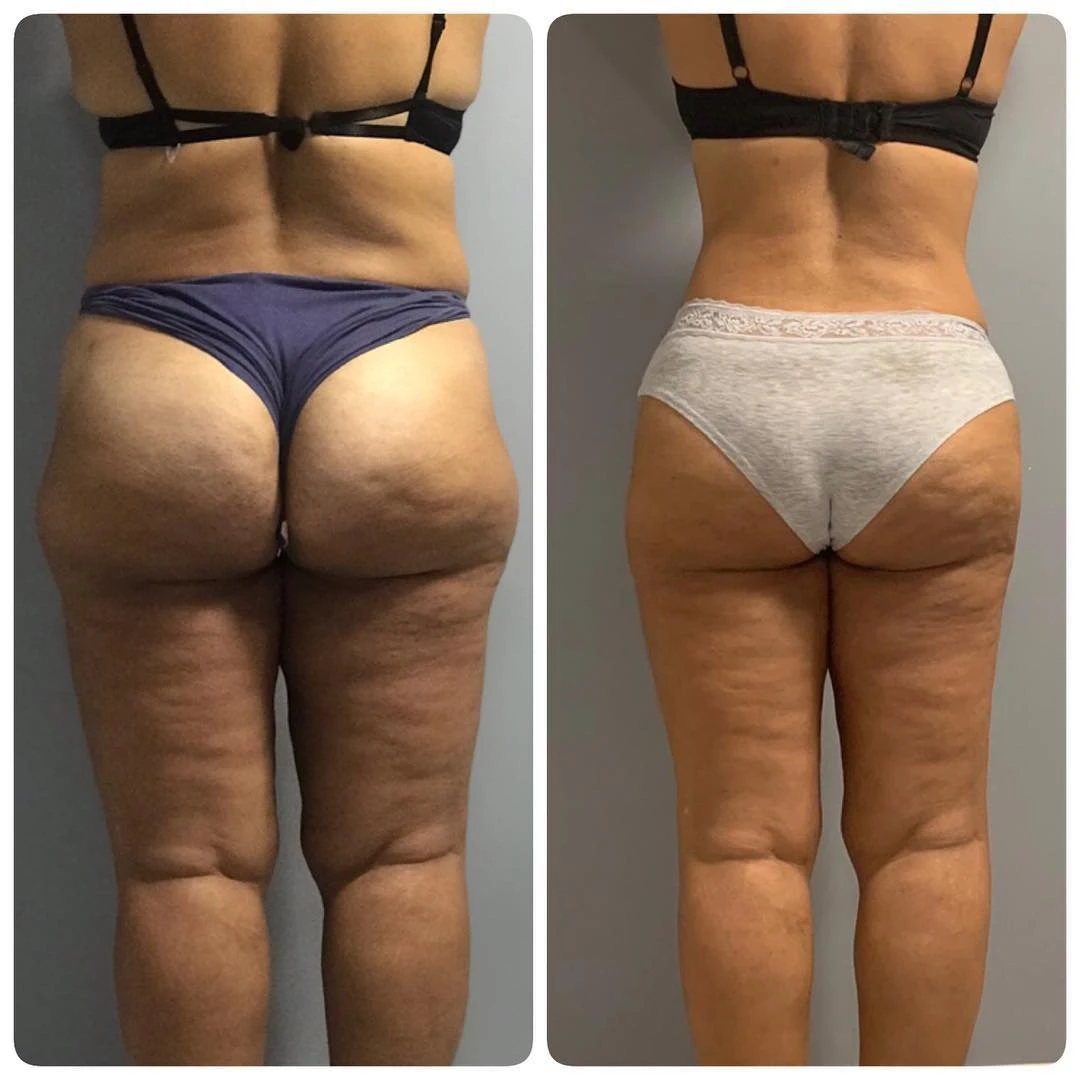 Love handle fat freezing 2