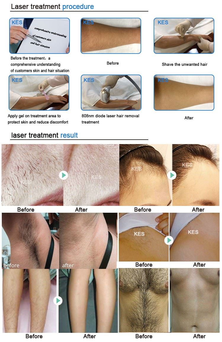 diode laser hair removal