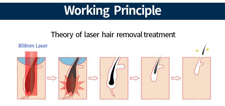 diode laser hair removal machine3